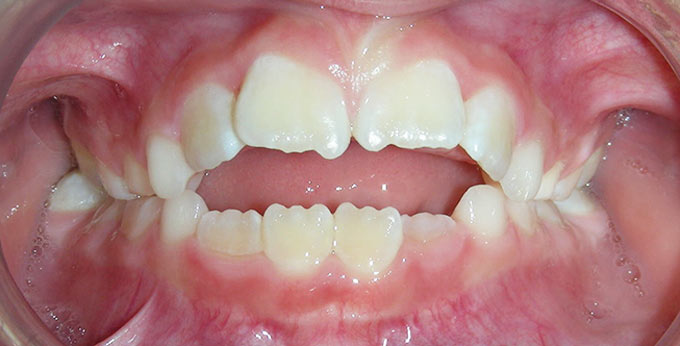 A thumb sucking habit resulted in an anterior open bite whereby the teeth do not overlap vertically